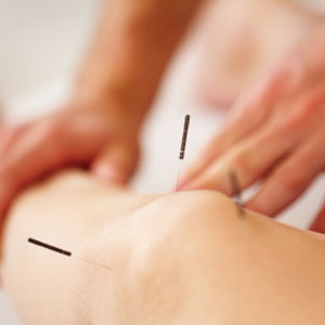 Acupuncture