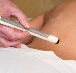 Moxibustion